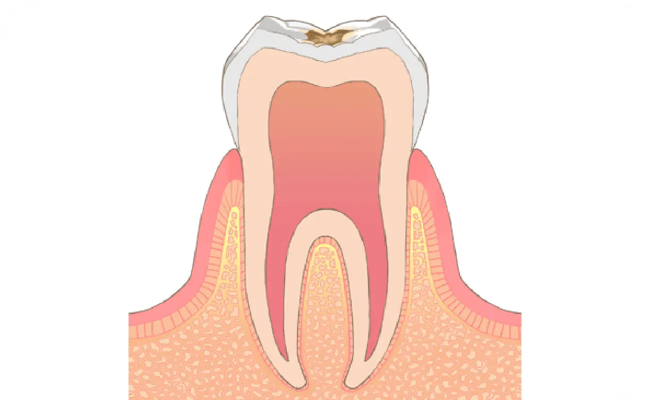 イメージ:C1→虫歯の中期状態