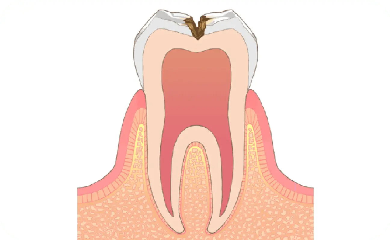 イメージ:C2→虫歯の後期状態（初期）