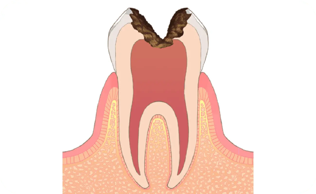 イメージ:C3→虫歯の後期状態（後期）