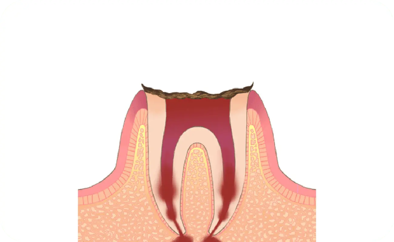 イメージ:C4→虫歯の末期状態