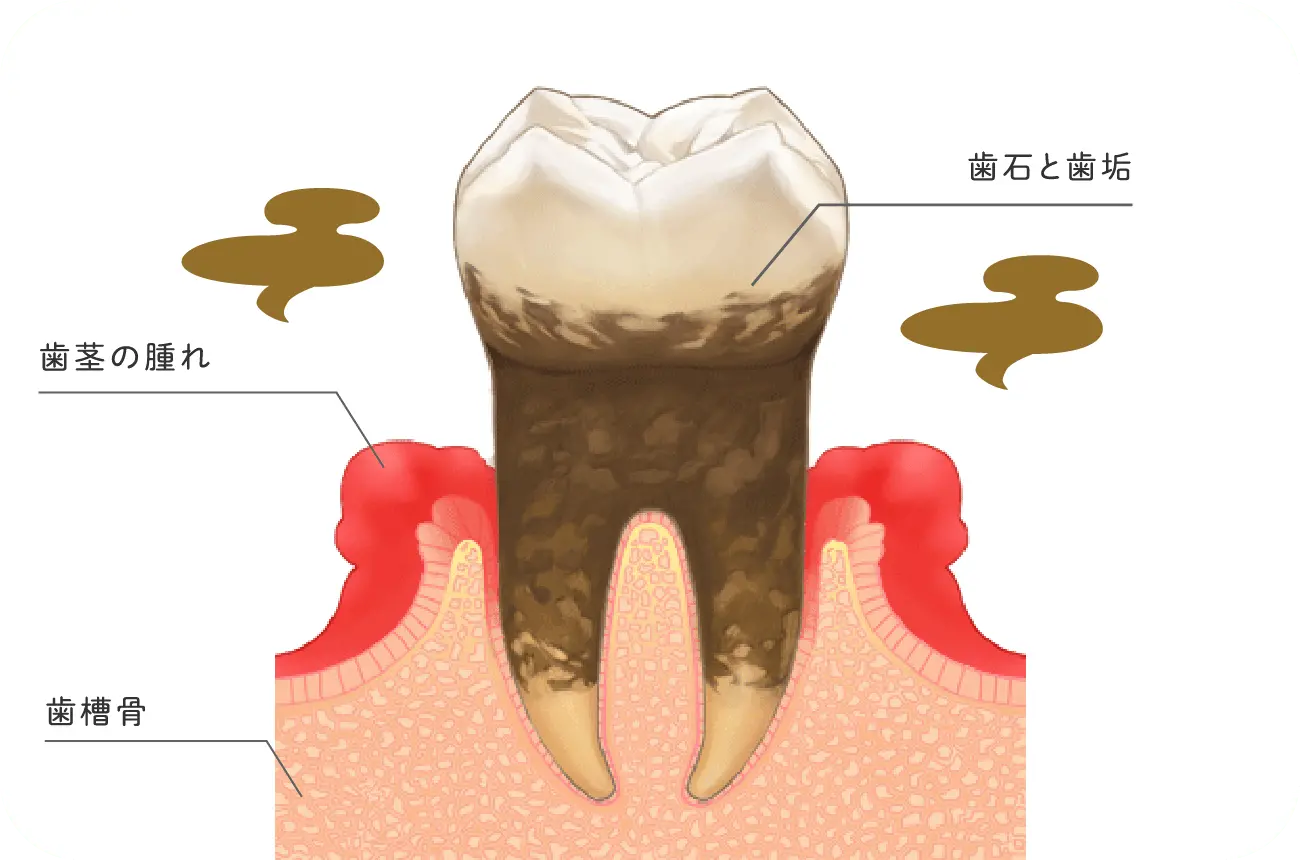 イメージ:歯茎に起こる化膿性の炎症