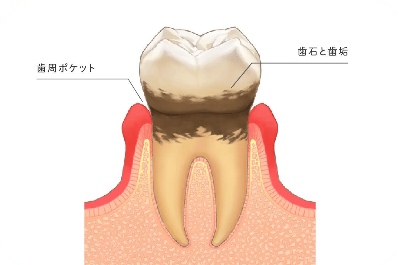 イメージ:歯の汚れからの細菌の繁殖