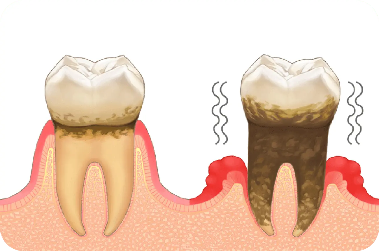イメージ:歯周病は、以下のような順で症状が進行します