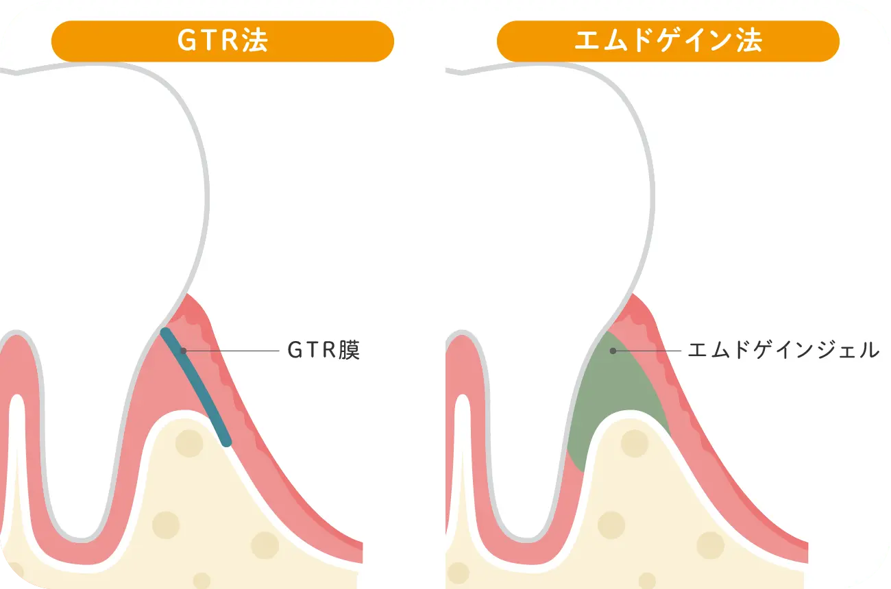 イメージ:歯周組織再生療法