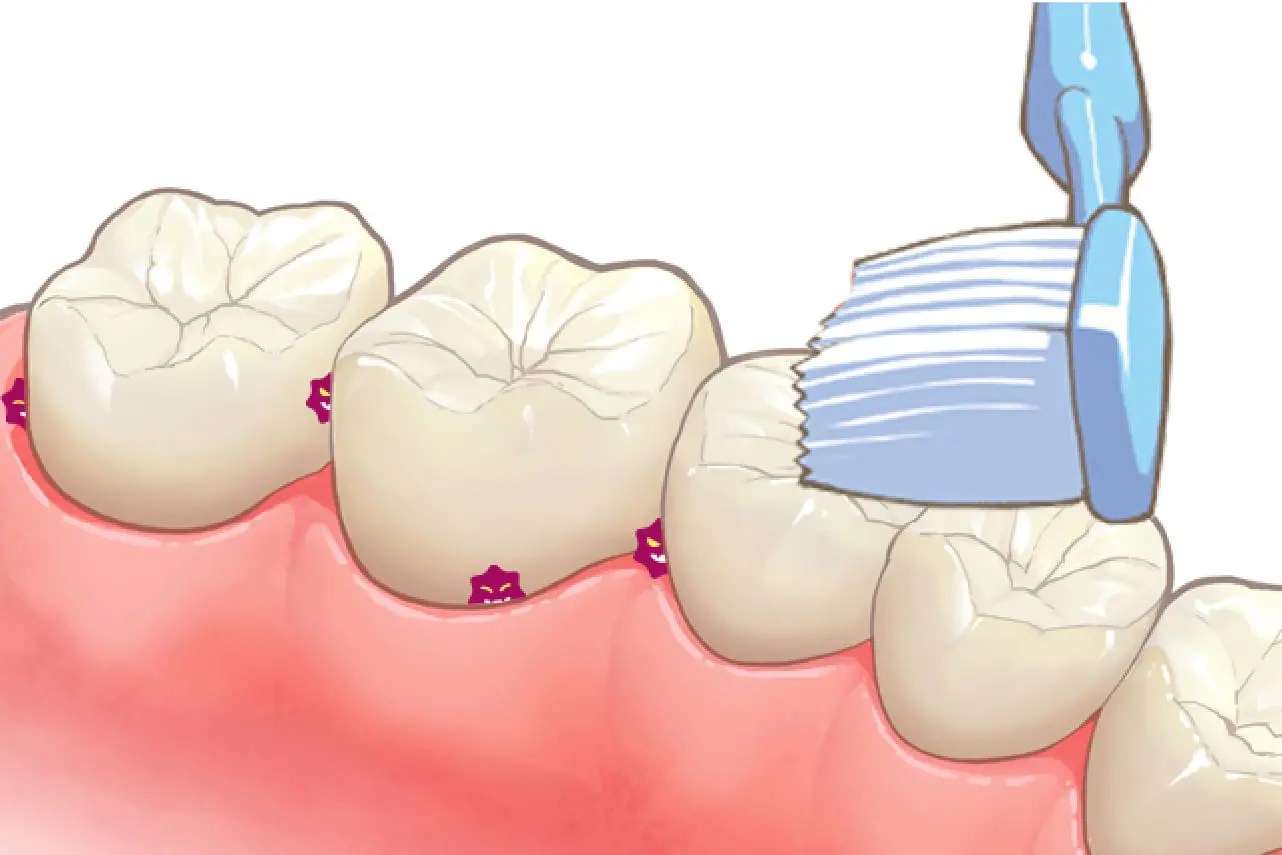 イメージ:プロが行う虫歯・歯周病予防