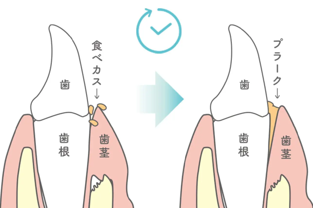 イメージ:食後の食べカスや汚れは、約8時間でプラーク（歯垢）ができるといわれています。 