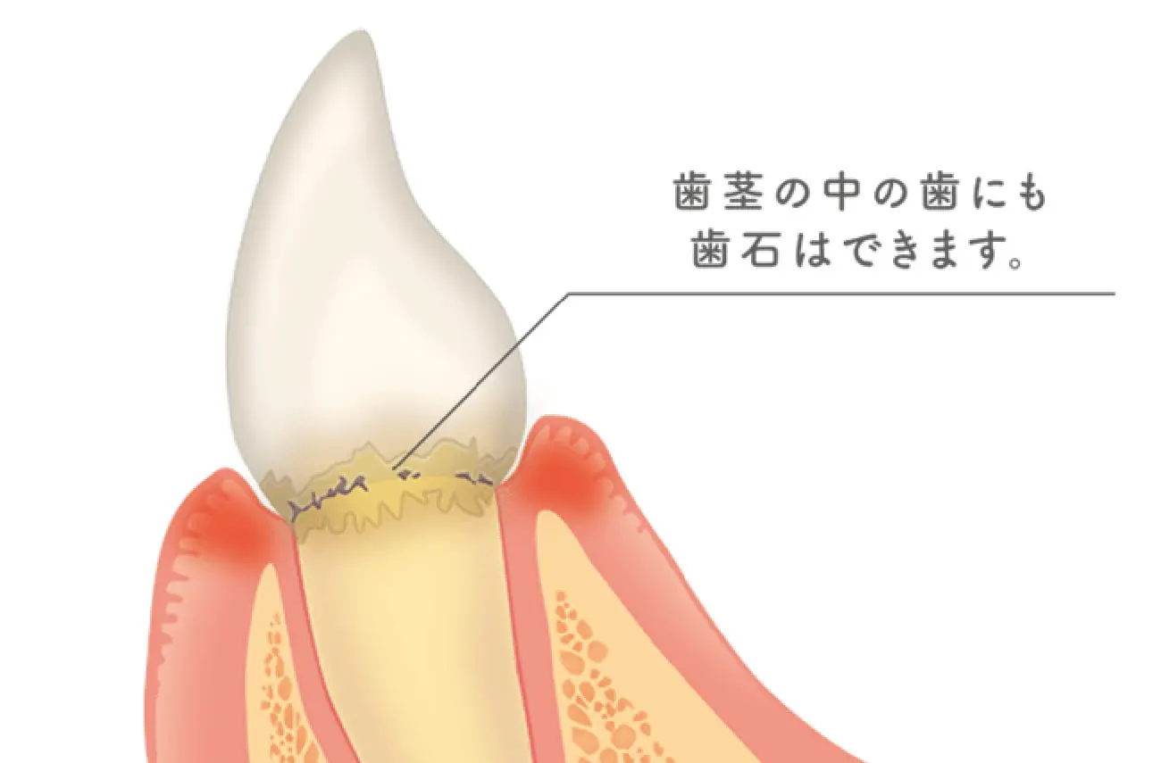 イメージ:お口の中で残ったプラークは、約48時間で歯石になり始めるといわれています。